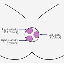 piles hemorrhoids 1 